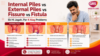 Internal Piles vs External Piles vs Fissure vs Fistula – Samjhein Farq Aasan Bhasha Mein