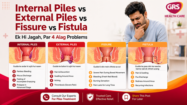 Internal Piles vs External Piles vs Fissure vs Fistula – Samjhein Farq Aasan Bhasha Mein